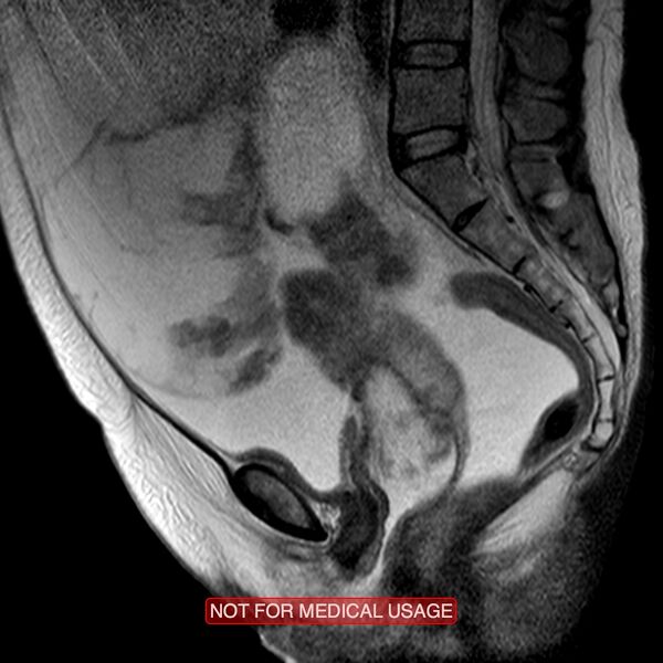 File:Adenocarcinoma of the cervix (Radiopaedia 28373-28615 Sagittal T2 7).jpg