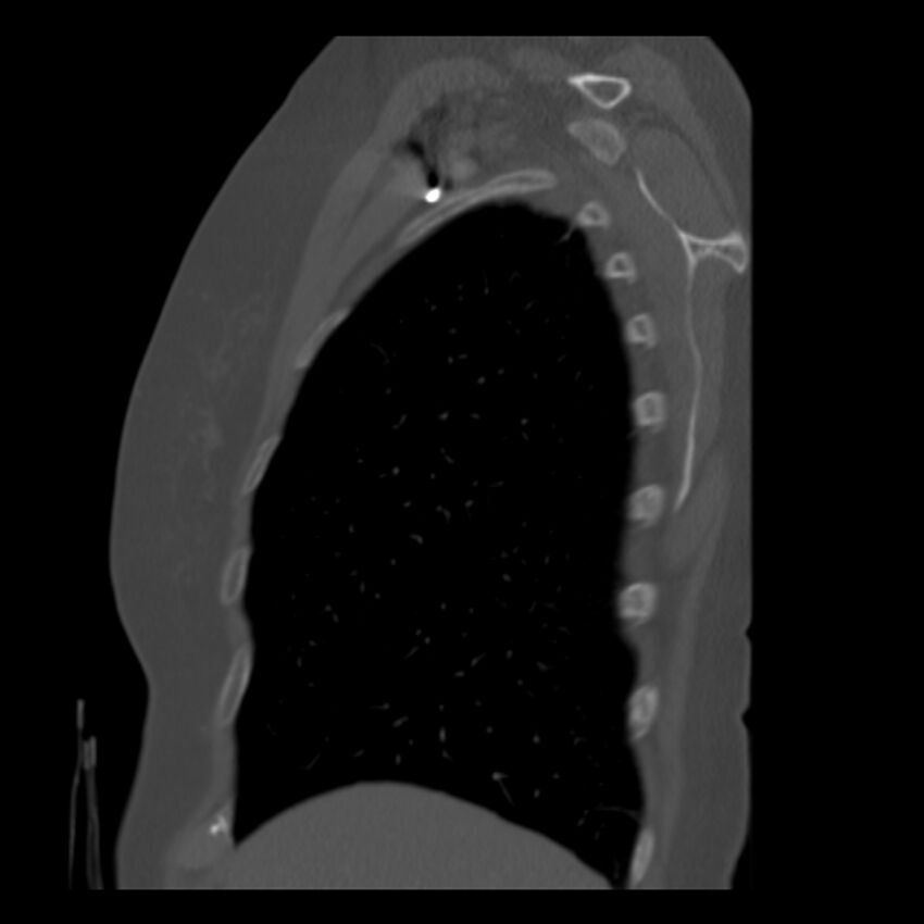 Adenocarcinoma of the lung (Radiopaedia 41015-43755 Sagittal bone window 12).jpg