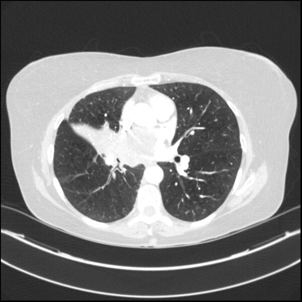 File:Adenocarcinoma of the lung (Radiopaedia 44205-47803 Axial lung window 50).jpg