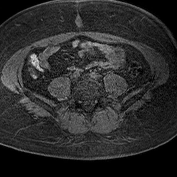 File:Adenomyoma of the uterus (Radiopaedia 9871-10439 Axial T1 fat sat 18).jpg