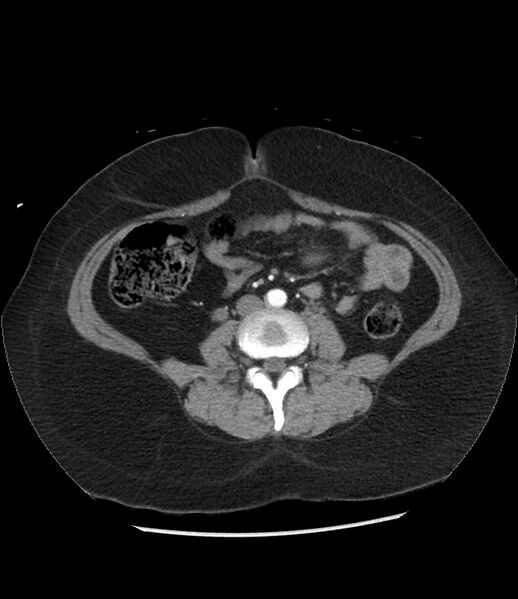 File:Adrenal cortical carcinoma with IVC invasion and thrombosis (Radiopaedia 34307-35597 Axial C+ arterial phase 51).jpg