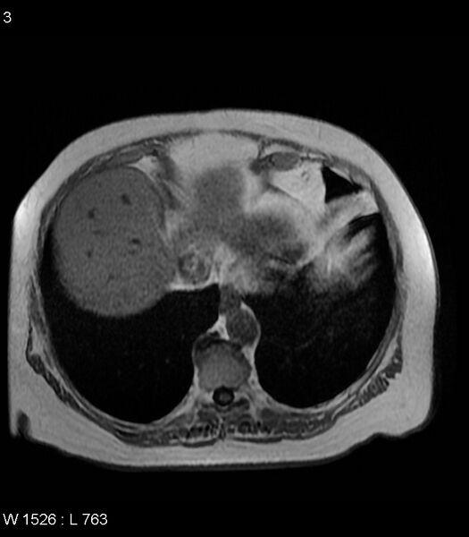 File:Adrenal myelolipoma (Radiopaedia 6765-7961 Axial T1 in-phase 3).jpg