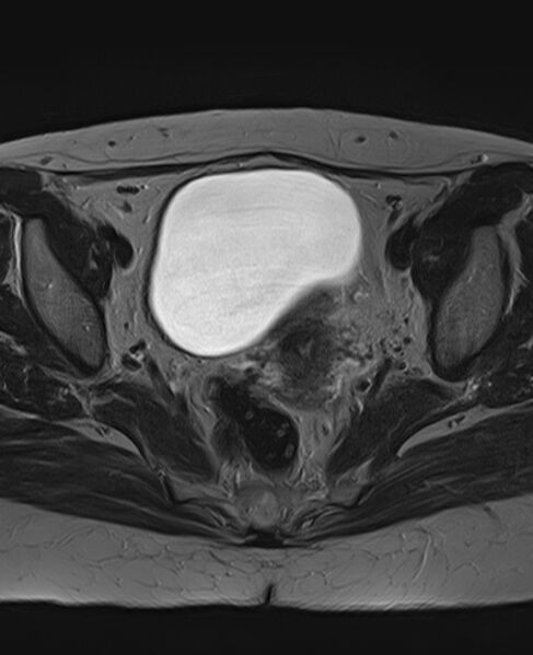 File:Adult granulosa cell tumor of the ovary (Radiopaedia 71581-81950 Axial T2 15).jpg