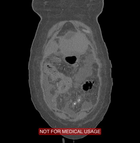 File:Amoebic enterocolitis with liver abscess (Radiopaedia 35100-36609 B 1).jpg