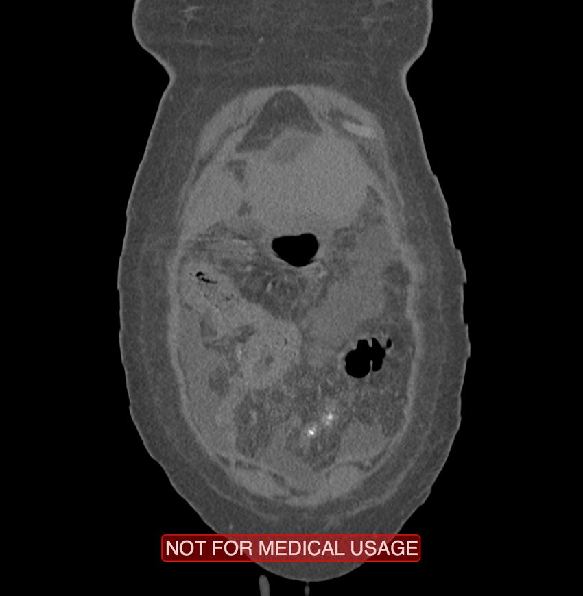 Amoebic enterocolitis with liver abscess (Radiopaedia 35100-36609 B 1).jpg
