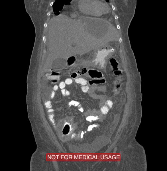 File:Amoebic enterocolitis with liver abscess (Radiopaedia 35100-36609 B 42).jpg