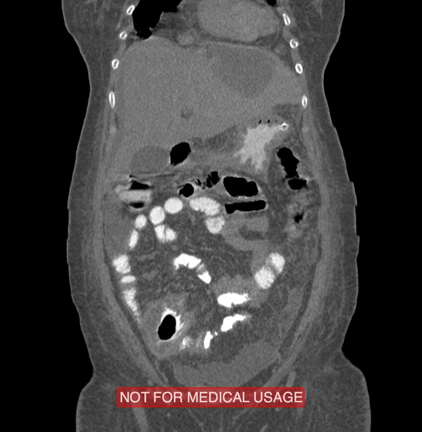 Amoebic enterocolitis with liver abscess (Radiopaedia 35100-36609 B 42).jpg