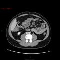 Ampullary carcinoma (Radiopaedia 56396-63056 C 56).jpg