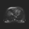 Ampullary tumor (Radiopaedia 27294-27479 T2 SPAIR 20).jpg