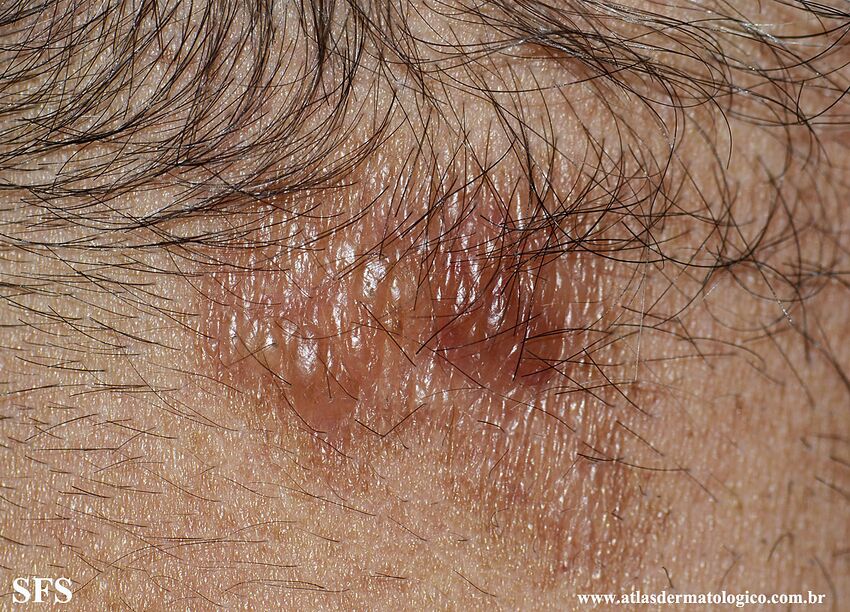 Amyloidosis-Nodular Amyloidosis (Dermatology Atlas 17).jpg