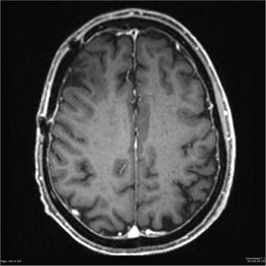 Anaplastic meningioma with recurrence (Radiopaedia 34452-35788 Axial T1 C+ 105).jpg