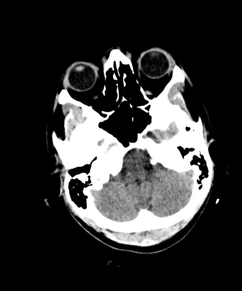 File:Angiomatous meningioma (Radiopaedia 79459-92578 Axial non-contrast 7).jpg
