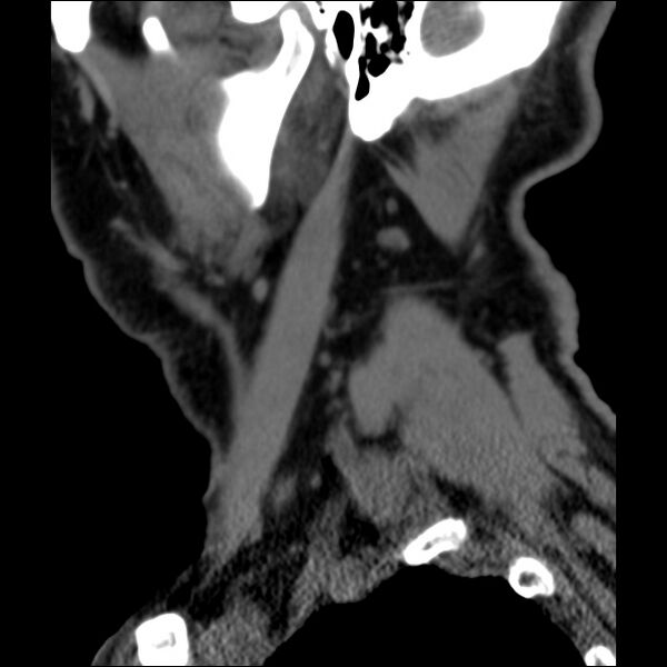File:Anterior cervical postdiscectomy arthrodesis (Radiopaedia 32678-33646 C 47).jpg