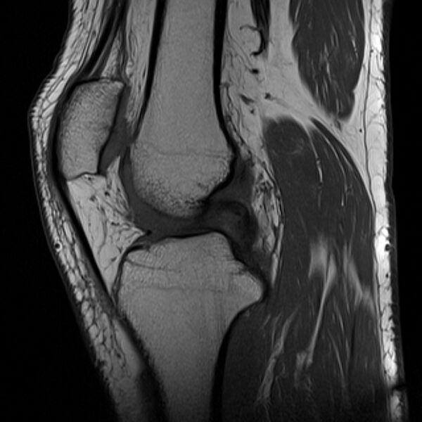 File:Anterior cruciate ligament tear - ramp lesion (Radiopaedia 71883-82322 Sagittal T1 14).jpg