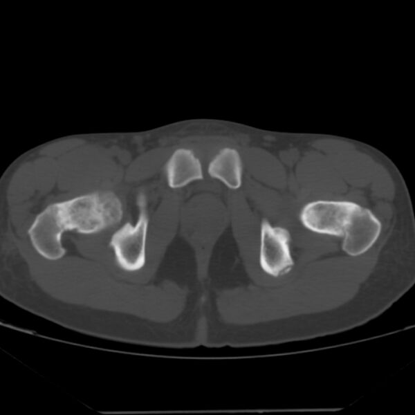File:Anterior inferior iliac spine avulsion fracture (Radiopaedia 49469-54627 Axial bone window 48).jpg