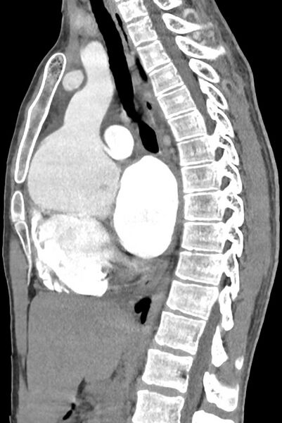 File:Aortic coarctation with aneurysm (Radiopaedia 74818-85828 B 84).jpg