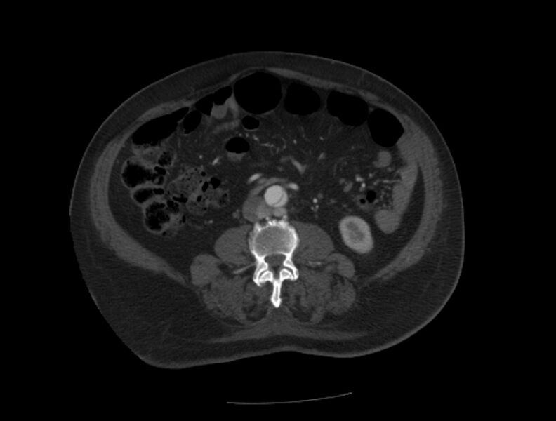 File:Aortic dissection (Radiopaedia 28802-29105 A 68).jpg
