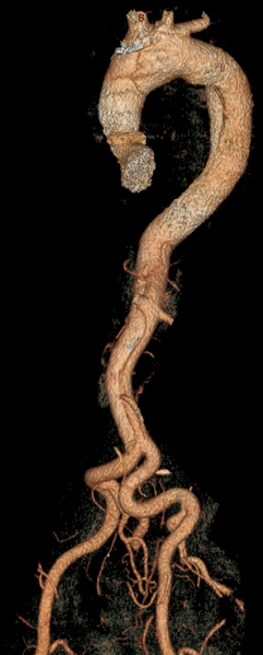 File:Aortic dissection (Radiopaedia 28802-29105 E 1).png
