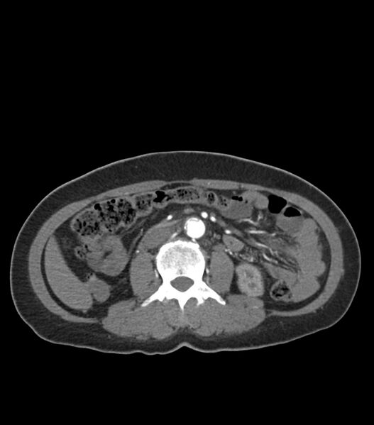 File:Aortic dissection with renal ischemia (Radiopaedia 76573-88338 A 78).jpg