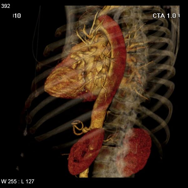 File:Aortic dissection with rupture into pericardium (Radiopaedia 12384-12647 C+ arterial phase 24).jpg