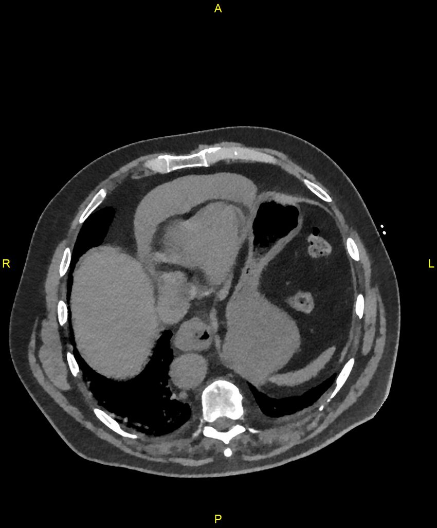 Aortic rupture (Radiopaedia 88822-105594 Axial non-contrast 184).jpg