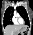 Aortic valve non-coronary cusp thrombus (Radiopaedia 55661-62189 C 26).png