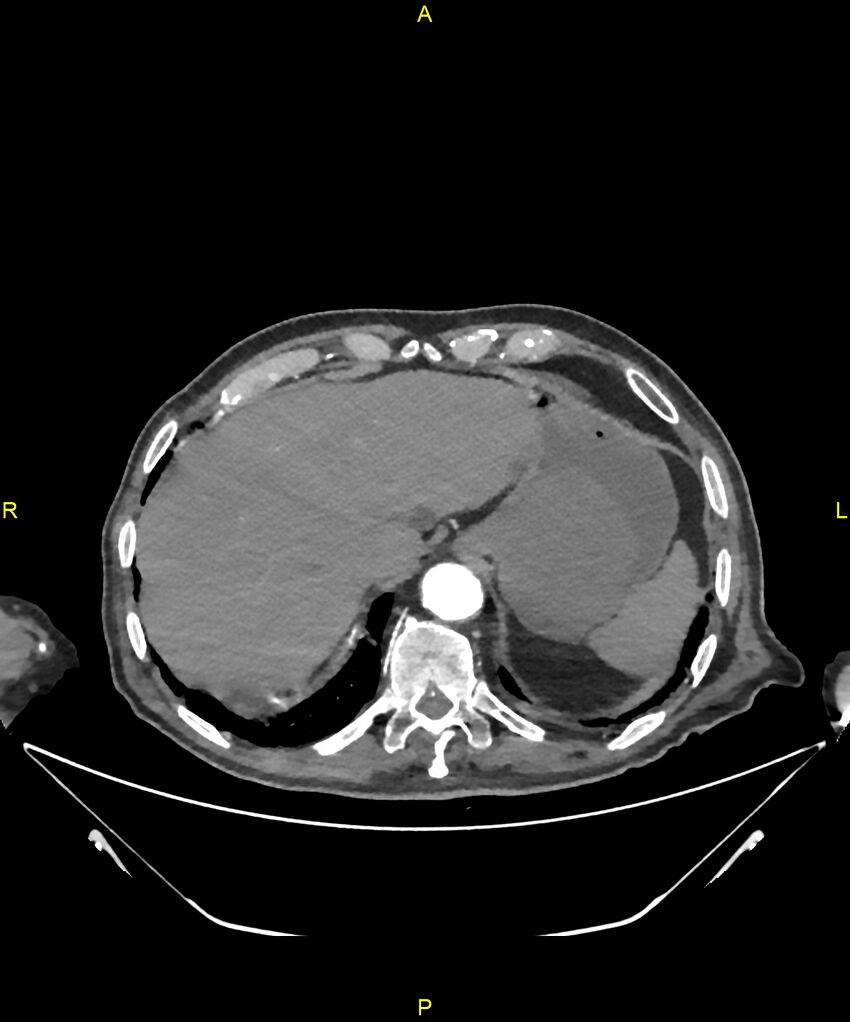 Aortoenteric fistula (Radiopaedia 84308-99603 B 39).jpg