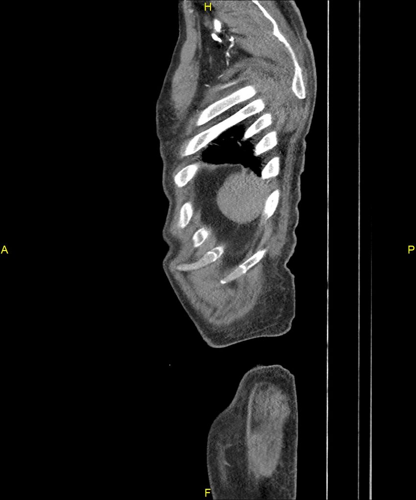 Aortoenteric fistula (Radiopaedia 84308-99603 C 319).jpg