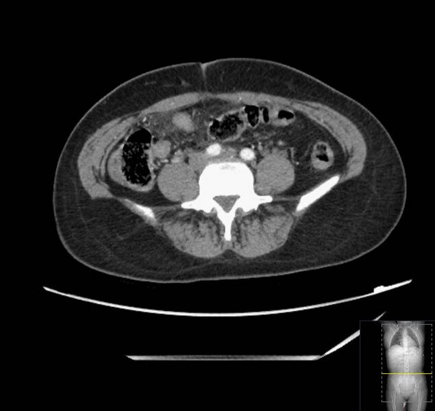 File:Appendicitis (CT angiogram) (Radiopaedia 154713-127660 Axial 37).jpg