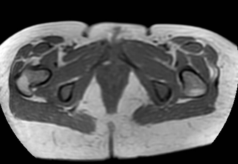 File:Appendicitis in gravida (MRI) (Radiopaedia 89433-106395 Axial T1 in-phase 72).jpg