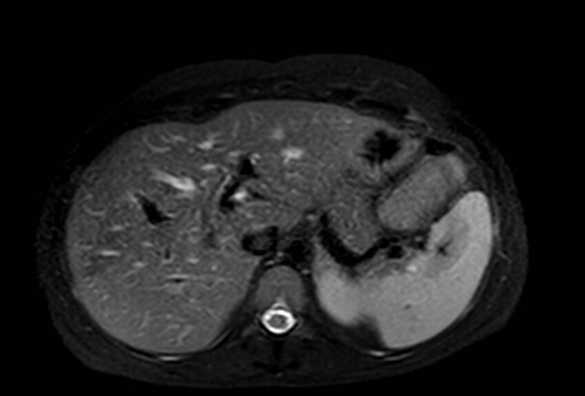 Appendicitis in gravida (MRI) (Radiopaedia 89433-106395 Axial T2 SPAIR 16).jpg