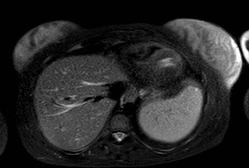 File:Appendicitis in gravida (MRI) (Radiopaedia 89433-106395 Axial T2 SPAIR 8).jpg
