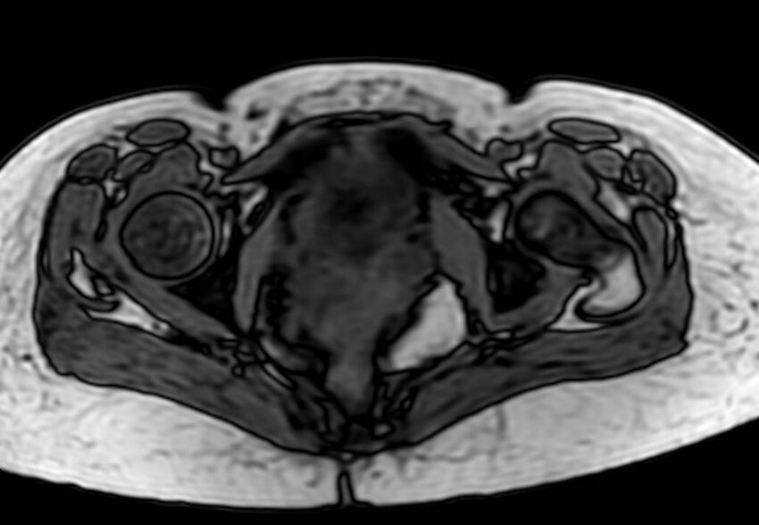 Appendicitis in gravida (MRI) (Radiopaedia 89433-106395 D 68).jpg