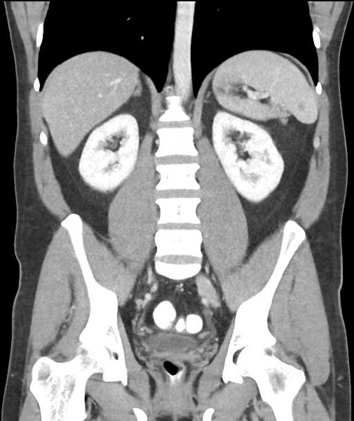 File:Appendicitis with cecal bar sign (Radiopaedia 31878-32830 A 40).jpg