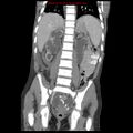 Appendicitis with phlegmon (Radiopaedia 9358-10046 B 47).jpg