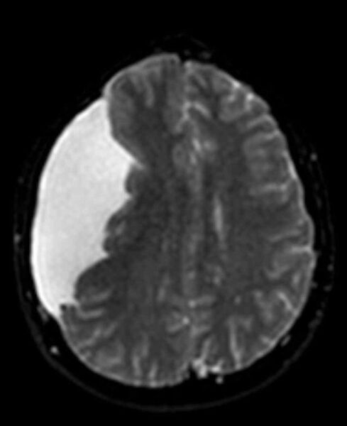 File:Arachnoid cyst- extremely large (Radiopaedia 68741-78451 Axial DWI 17).jpg