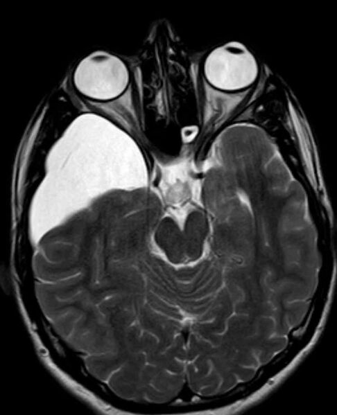 File:Arachnoid cyst- extremely large (Radiopaedia 68741-78451 Axial T2 10).jpg