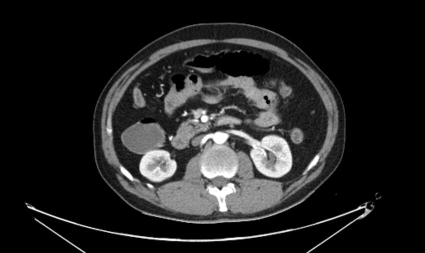 Arterial occlusive mesenteric ischemia (Radiopaedia 84641-100060 A 58).jpg
