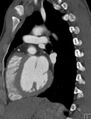 Arterial switch procedure (Radiopaedia 31607-32493 Sagittal 18).jpg