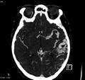 Arteriovenous malformation - cerebral (Radiopaedia 8172-14682 A 9).jpg