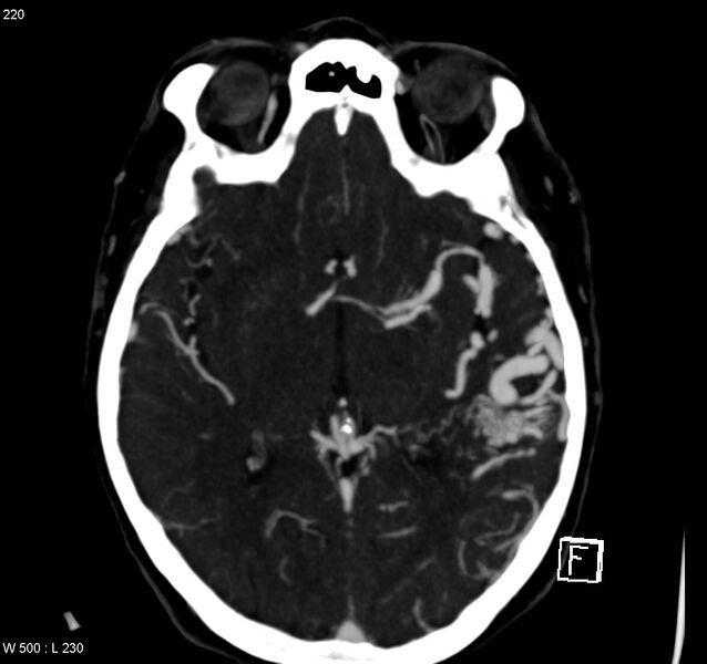 File:Arteriovenous malformation - cerebral (Radiopaedia 8172-14682 A 9).jpg
