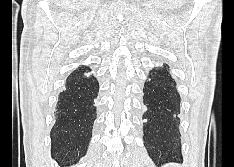 File:Asbestos pleural placques (Radiopaedia 57905-64872 Coronal lung window 261).jpg