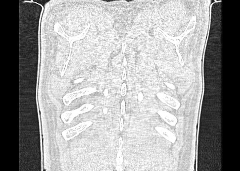 File:Asbestos pleural placques (Radiopaedia 57905-64872 Coronal lung window 285).jpg