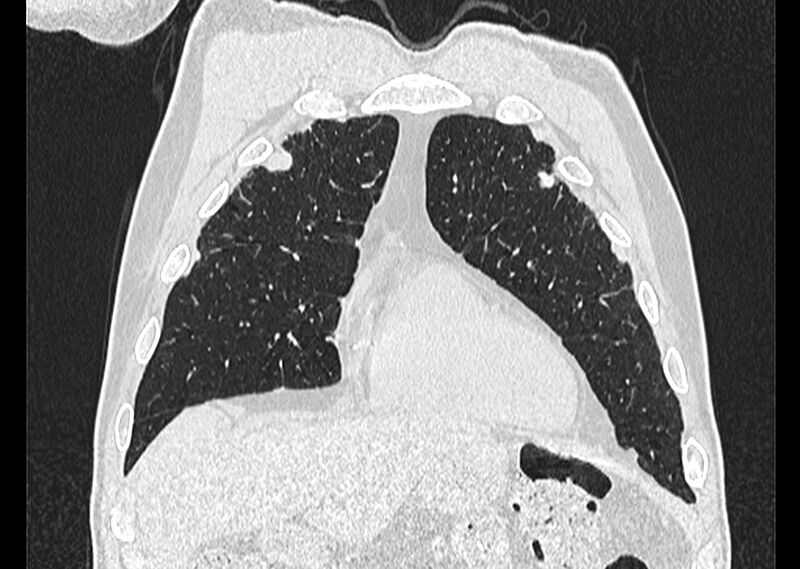 File:Asbestos pleural placques (Radiopaedia 57905-64872 Coronal lung window 57).jpg