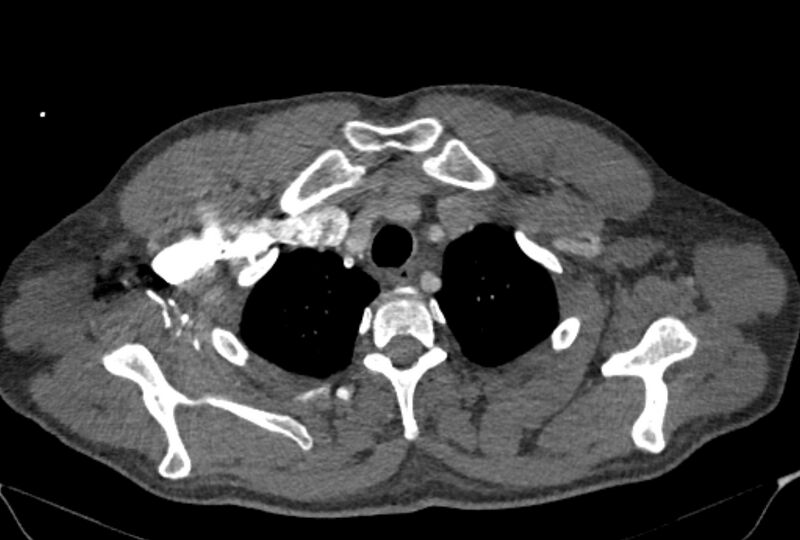 File:Ascending aortic aneurysm (Radiopaedia 86279-102297 C 6).jpg