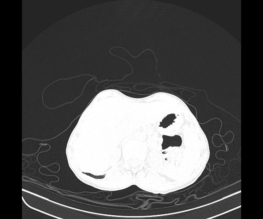Aspergillomas (Radiopaedia 66779-76110 Axial lung window 48).jpg