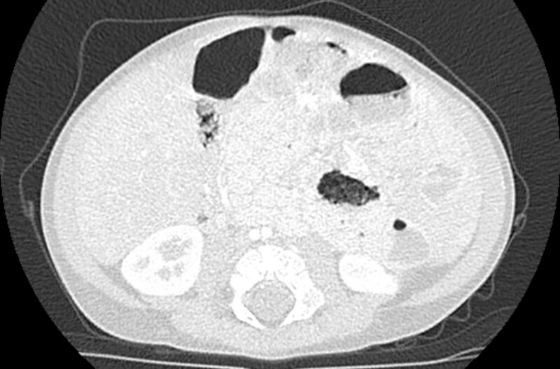 File:Asplenia syndrome (Radiopaedia 73083-83792 Axial lung window 104).jpg