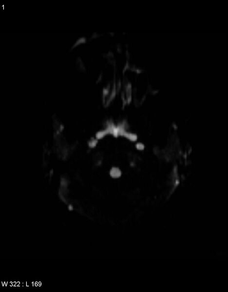 File:Astroblastoma (Radiopaedia 39792-42217 Axial DWI 19).jpg