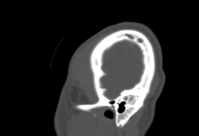 Asymptomatic occipital spur (Radiopaedia 87753-104201 Sagittal bone window 297).jpg