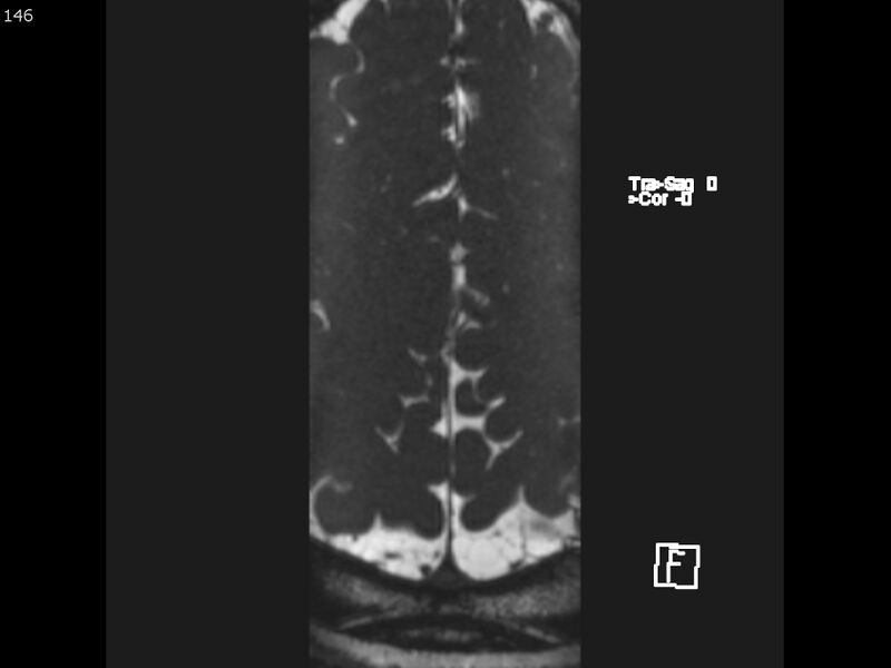 File:Atypical meningioma - intraosseous (Radiopaedia 64915-74572 Axial CISS 146).jpg